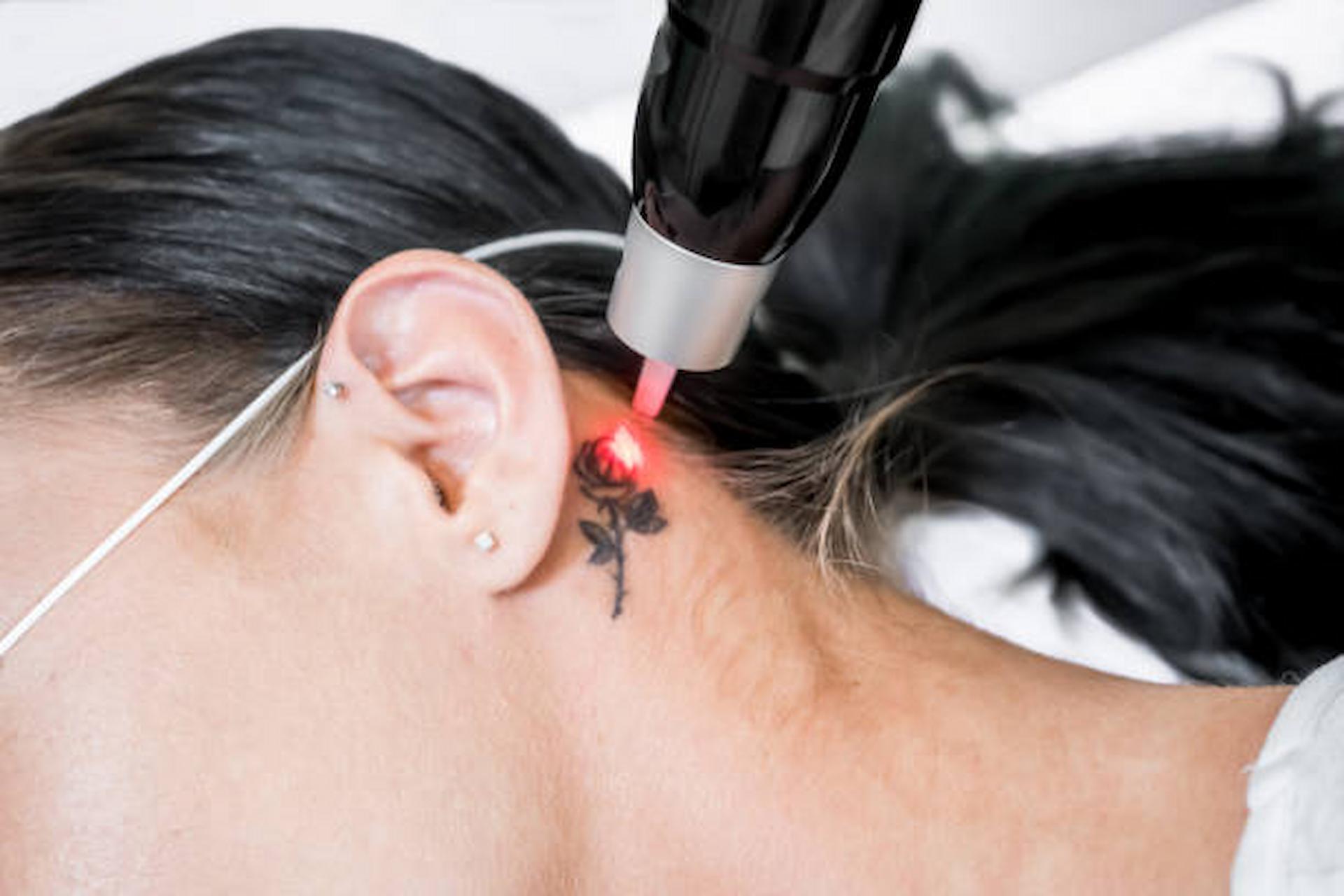 4 Things To Know Before Getting Laser Tattoo Removal